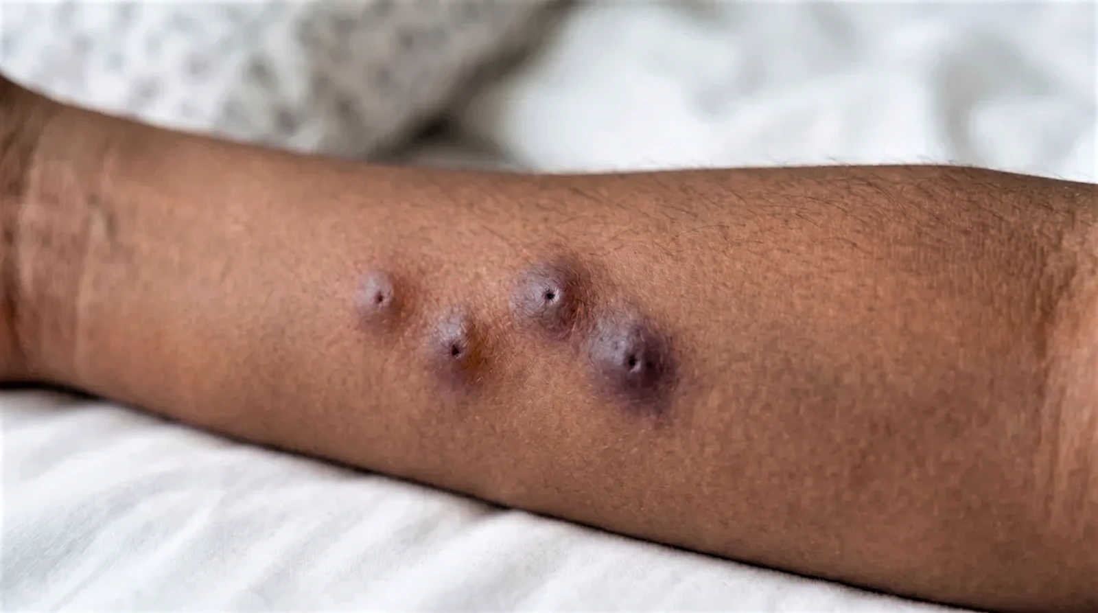 bed bug bites on darker skin tones appearance Close-up photograph of multiple bed bug bites on a darker-skinned forearm. The bites appear as deep purple, brownish-red raised marks in a line pattern against white bedding.