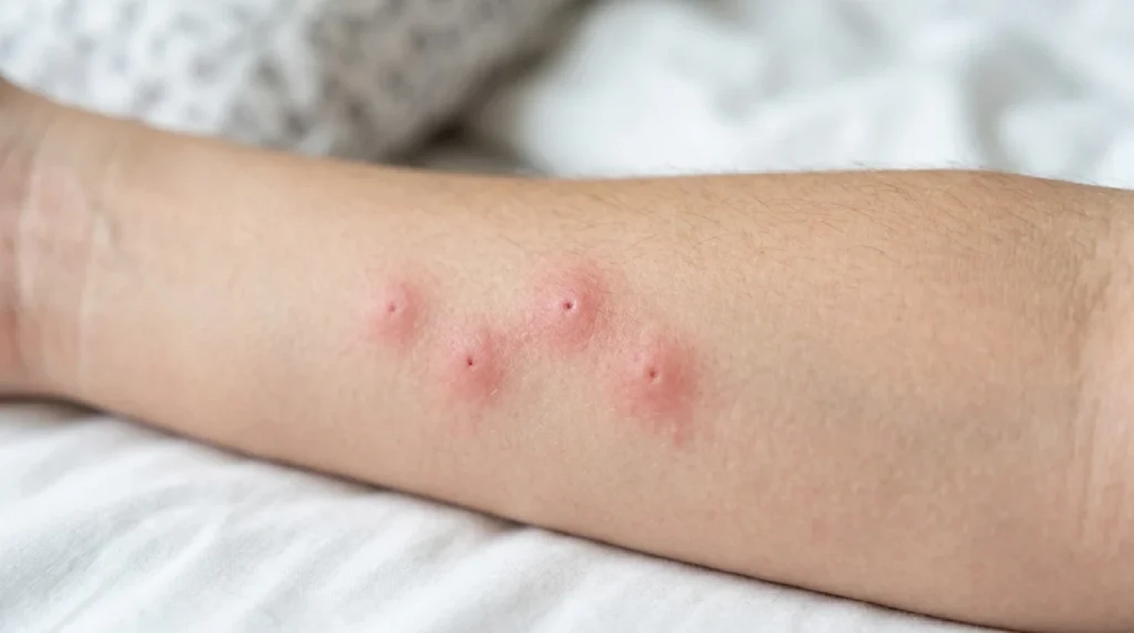 bed bug bites on fair skin pattern Close-up photograph of four red, raised bed bug bites arranged in a distinct line on a light-skinned forearm, showing central puncture marks against white bedding.