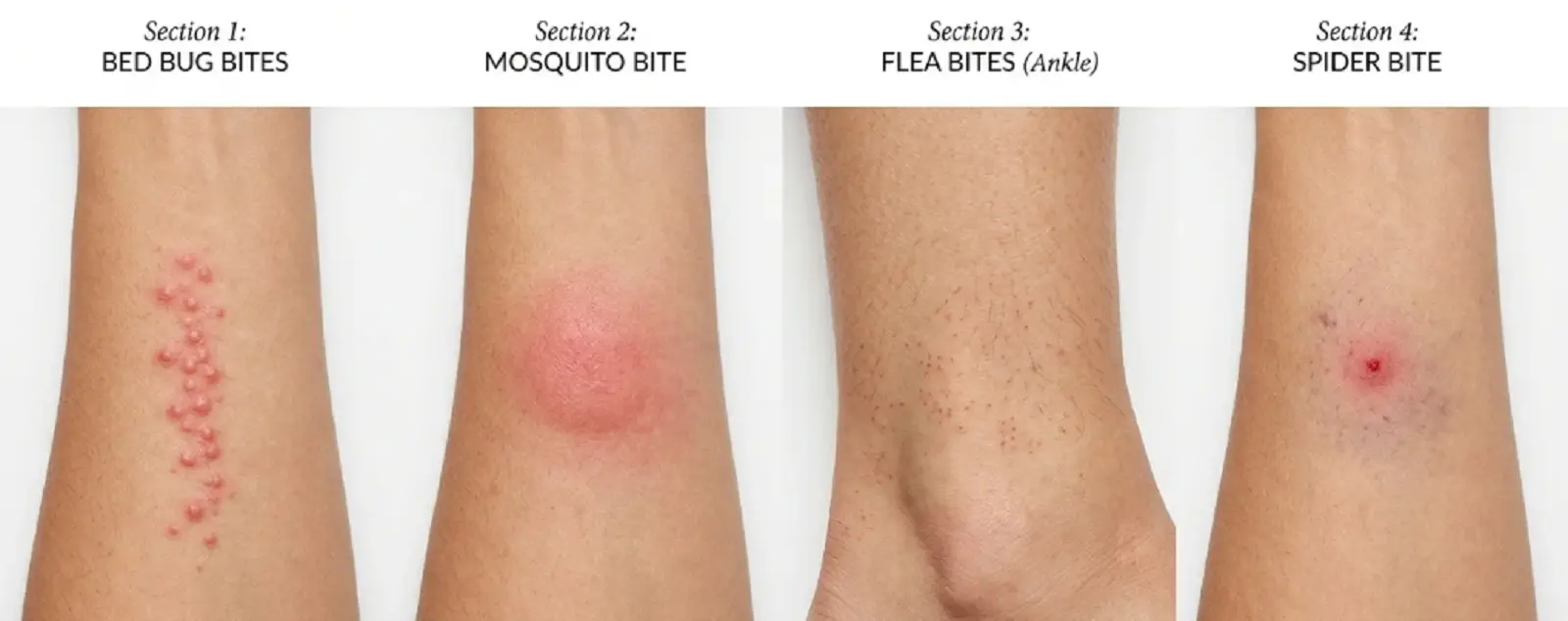bed bug bites vs mosquito flea spider bite comparison 1 Side by side comparison of bed bug bites versus mosquito flea and spider bites on human skin